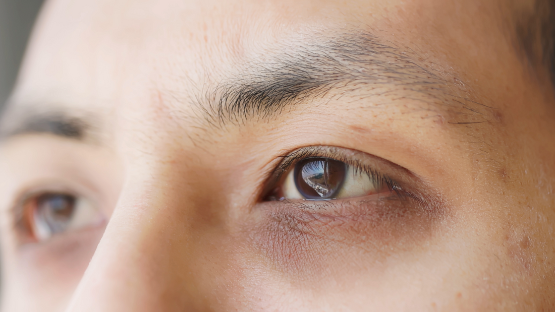 How to Remove Dark Circles Permanently?